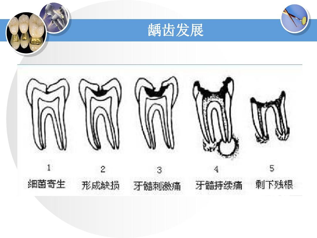 龋齿最新科研进展及其影响